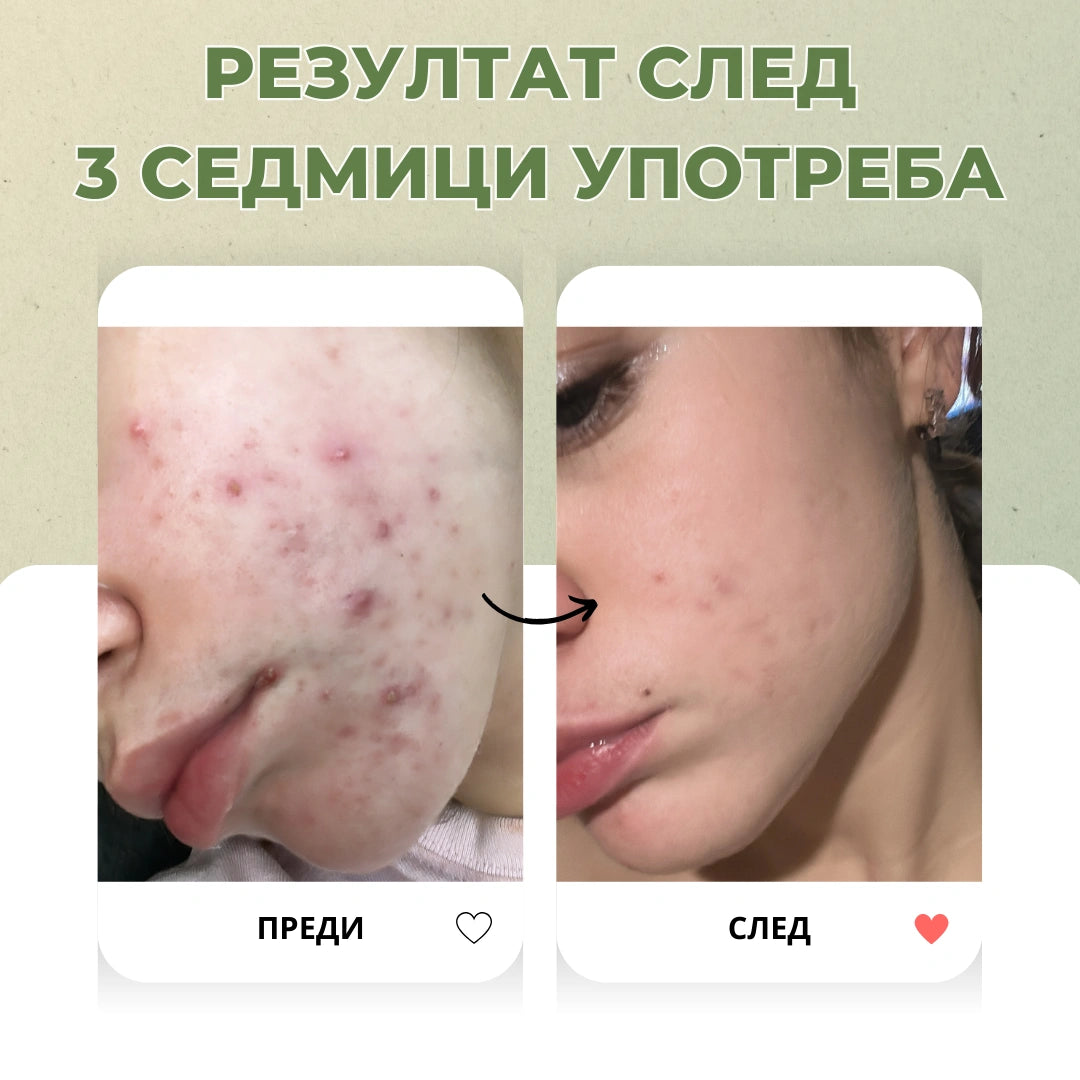 Био еликсир с масло от таману при Акне